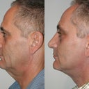 me before and after
