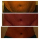 Before, 4 weeks post op, 3.5 months post op