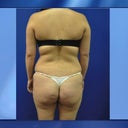 Picture before surgery taken at Dr. Cortes office