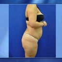 Picture before surgery side view