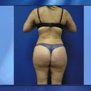 Picutre  after 900 cc of fat into each buttock