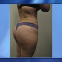 picture taken from home 2 months after surgery