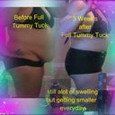 Before & 3 weeks After FTT