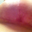 Under left breast. Scar faded more than right.