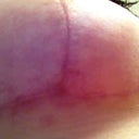 Right under breast. Haven't done anything different.
