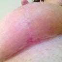 Underboobs have both healed well.