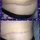 See...the pleating really does to down. Look how swollen I was, but didn't feel so at the time, crazy!