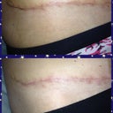 This side is much flatter even tho it's not translating on pic. The internal stitches are finally dissolving.