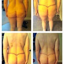 Back Pre-op, 4 days post, 11 days post, 25 days post