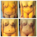 Front Pre-op, 4 days post, 11 days post, 25 days post