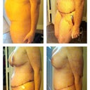 Left Pre-op, 4 days post, 11 days post, 25 days post