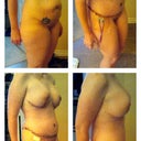 Right Pre-op, 4 days post, 11 days post, 25 days post