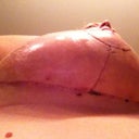Post Op Day 19--second day without tape on incisions