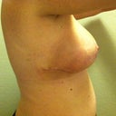 Post Op Day 19--second day without tape on incisions