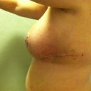 Post Op Day 19--second day without tape on incisions
