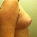 Post Op Day 19--second day without tape on incisions