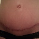 7 weeks post op..scar is VERY red but laying flat! Can't wait for bikini belly!!