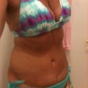 Six weeks post op