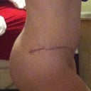 Side view showing scar