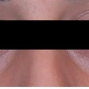 Before Restylane