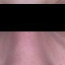 Two weeks following Restylane