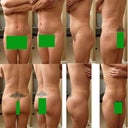 Post Op 10/13 15 days post op