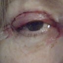 Day 1 - shortly after the operation