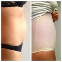 Morning of surgery and then 1 week later, looking pregnant in my garment. :-(