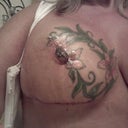 tram flap side only 2 weeks post op