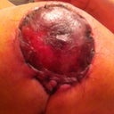 Close up of right nipple w/ Issue.  4 Days Post Op