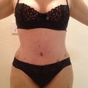 Day 6 PO after being up all day. swollen but still better than before