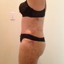 day 6 PO. tummy is tight but i feel like a tree trunk- and my thighs are still bigger than i'd hoped (+ swelling)  and i have lots bruising, but its starting to turn yellow of