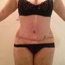 Day 6 PO scar is better, doc says it will move lower when i stretch out