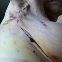 Right side, 5 days post-surgery