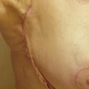 Left side, 3 wks post-surgery.  
It still looks very much like this, except not as red.  The skin that hangs out won't ever smooth out, and I'm not talking about a scar disappearing.  I don't expect that to happen.  I just don't want skin flaps!