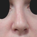 2 months post op- front view