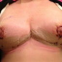 2nd day post op