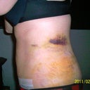 Day #5 post op tummy tuck side view