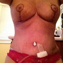 1 week PO...started my period...stomach hard and swollen.  Very bruised (I bruise extremely easily).