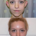 Before and one week after the procedure.