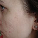 Left side before treatment