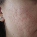 Right side before treatment