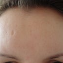 Forehead before treatment