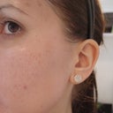 Left side 2 hours after treatment