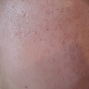 Right side 2 hours after treatment