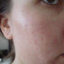 Right side day 3