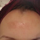 Forehaed day 5 - start to peel off