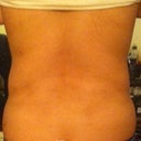 ~1 year, lumps are more noticeable