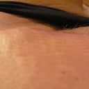 Seroma, trying to show you guys it is that bump it is hard as rock, that is what he sticks the needle in at my incsion and drains, he also has been taking a little fluid out of my belly