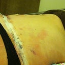 Laying down Post Op day 3